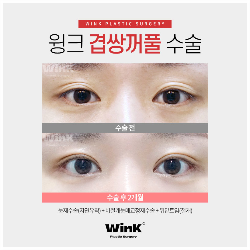 겹주름쌍꺼풀 겹쌍 쌍꺼풀여러겹 겹쌍꺼풀수술은 윙크성형외과! 관련 이미지 6
