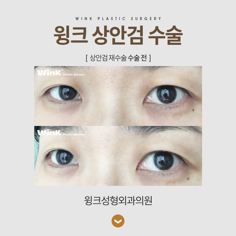 If You Want Upper Eyelid Surgery to Look Natural image 7