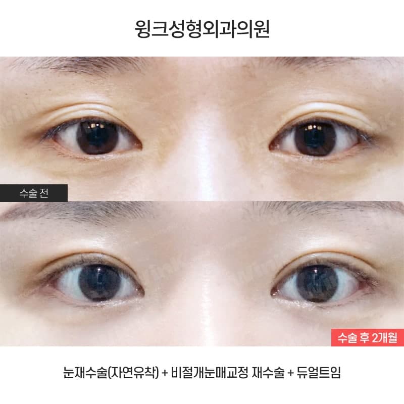 Wink canthoplasty and lower canthoplasty to overcome a cramped-looking eye shape! image 1
