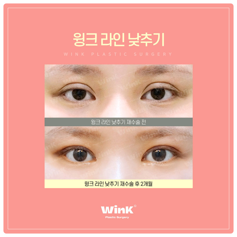 소세지눈재수술 서울눈재수술 눈재수술병원 알아본다면 윙크성형외과 관련 이미지 6