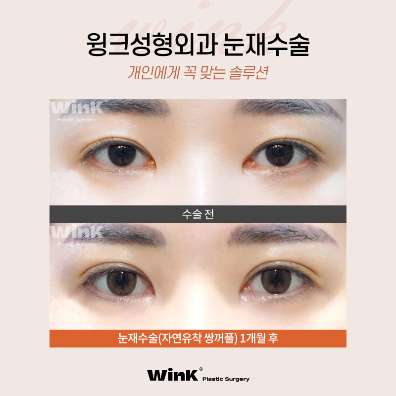 윙크성형외과에서 알려드리는  다양한 실패원인! 눈재수술후기 신사눈재수술잘하는곳 관련 이미지 6