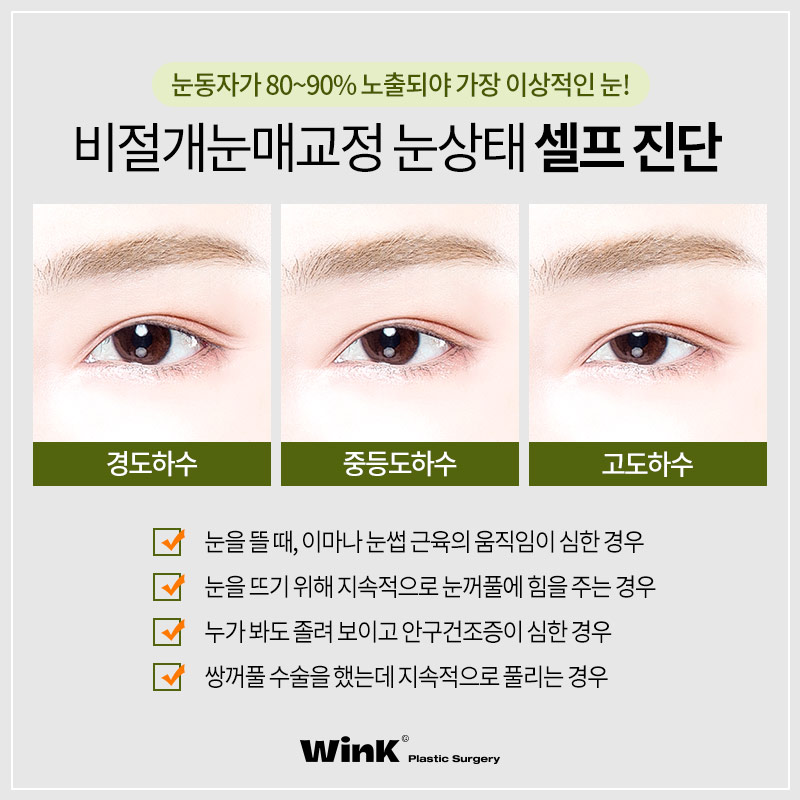 Non-incisional Eye Correction Review: A Natural, Clear Eye Shape! image 5