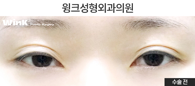 Case Examples of Correcting Uneven Eyes Through Ptosis Correction image 2