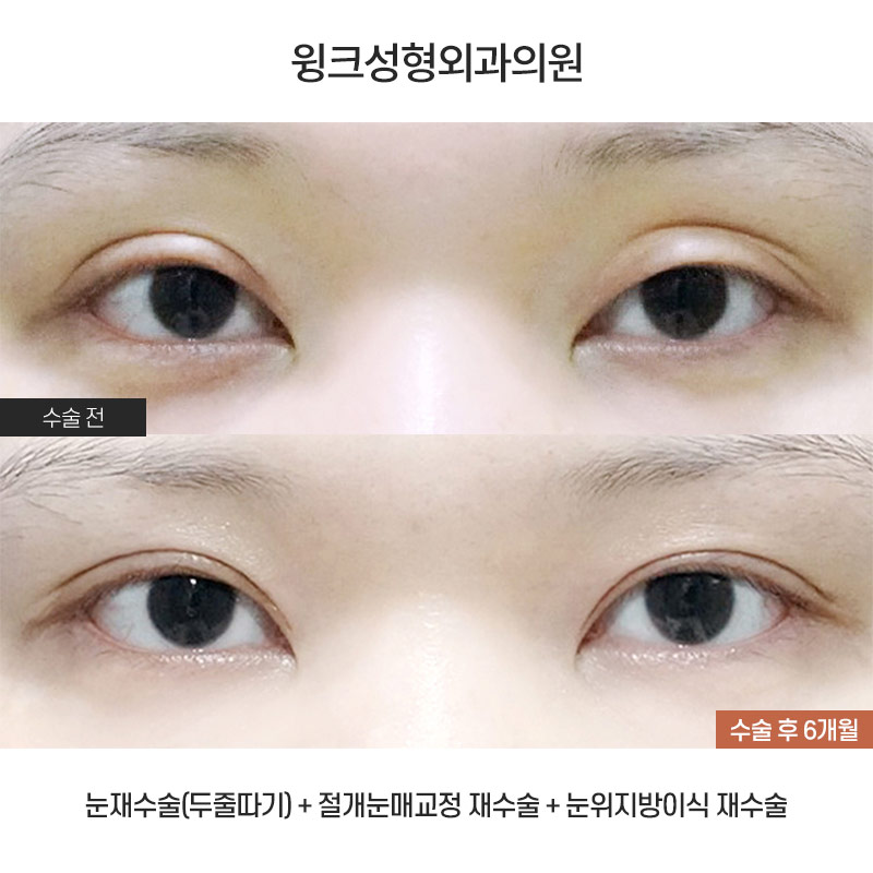 Shall We Learn About the Skin-Preserving Incision Method for Double-Line Reduction? image 1