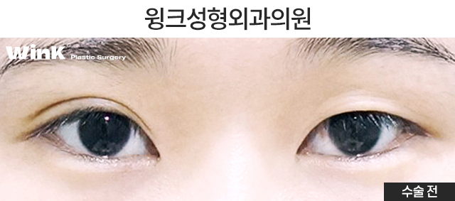 Is It Okay to Have Double Eyelid Surgery on Only One Side? image 2