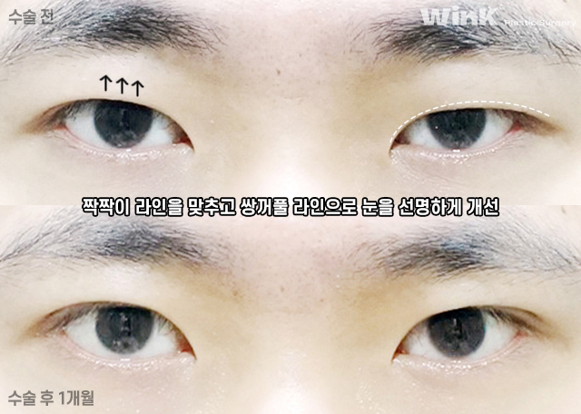 남자 속쌍꺼풀 눈매교정에 대해 알아볼까요? 관련 이미지 4