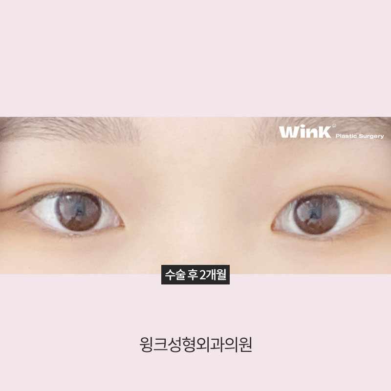 A Natural Line That Looks Just Like Your Original Eyes: In-line Double Eyelids image 10