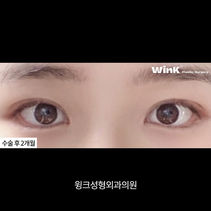 Double-Eyelid Stitching, WINK Plastic Surgery Natural Adhesion image 6