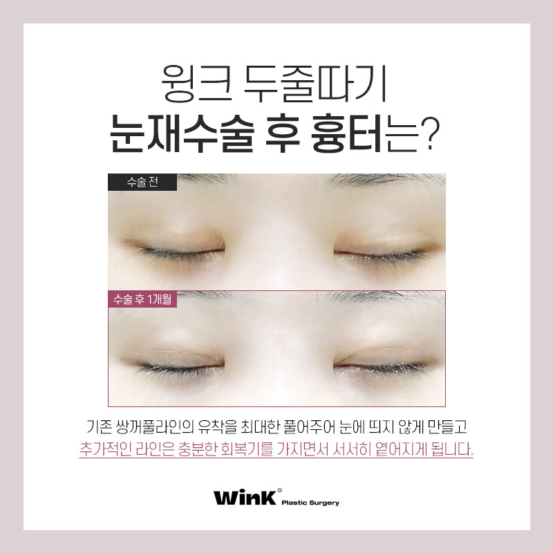 두껍고 높은 소세지눈? 윙크성형외과 두줄따기 눈재수술로 개선 관련 이미지 6