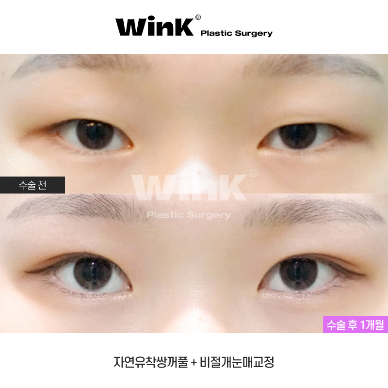 원래 내  눈 같은 자연스러움  윙크성형외과 자연유착 관련 이미지 1