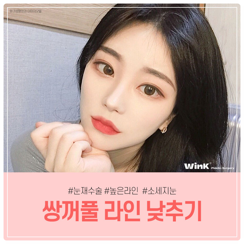 소세지눈재수술 서울눈재수술 눈재수술병원 알아본다면 윙크성형외과 관련 이미지 1