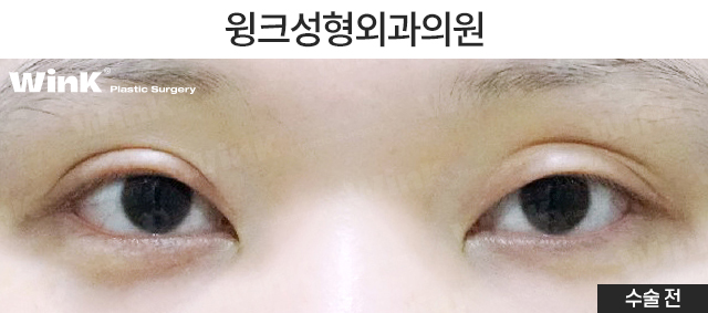 Shall We Learn About the Skin-Preserving Incision Method for Double-Line Reduction? image 2