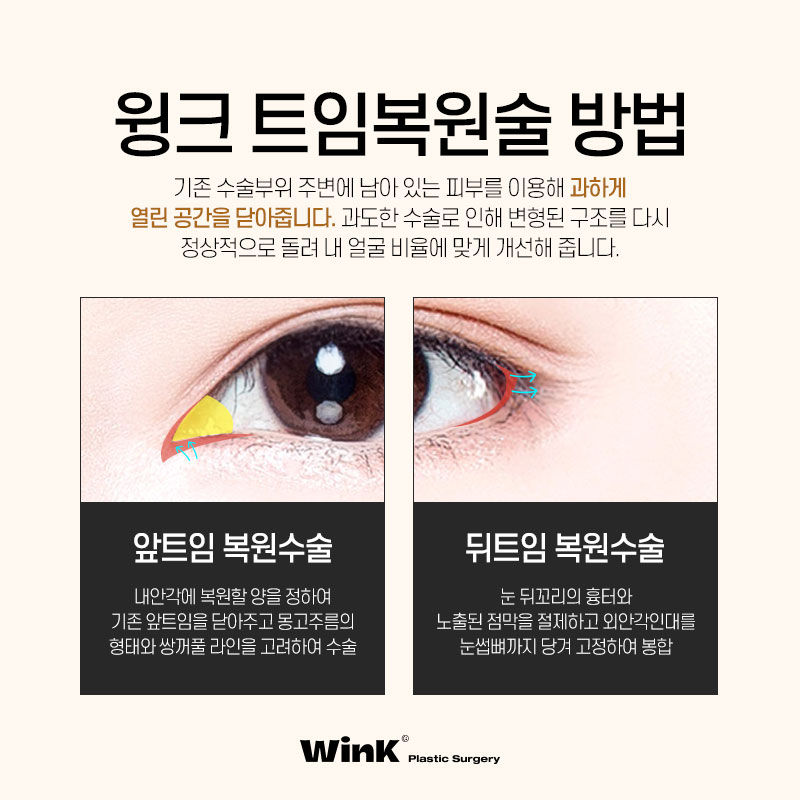 과도한 트임으로 부자연스러운 눈, 윙크성형외과 트임복원술로 해결하자! 관련 이미지 5