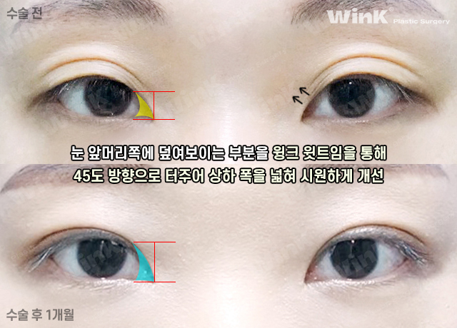 Let’s Take a Look at the Changes and Effects Before and After Upper Epicanthoplasty image 7