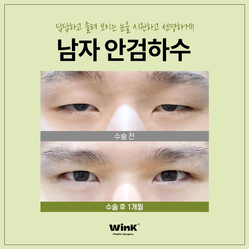 Male Ptosis? Improved Naturally and Unnoticeably at Wink Plastic Surgery! image 7