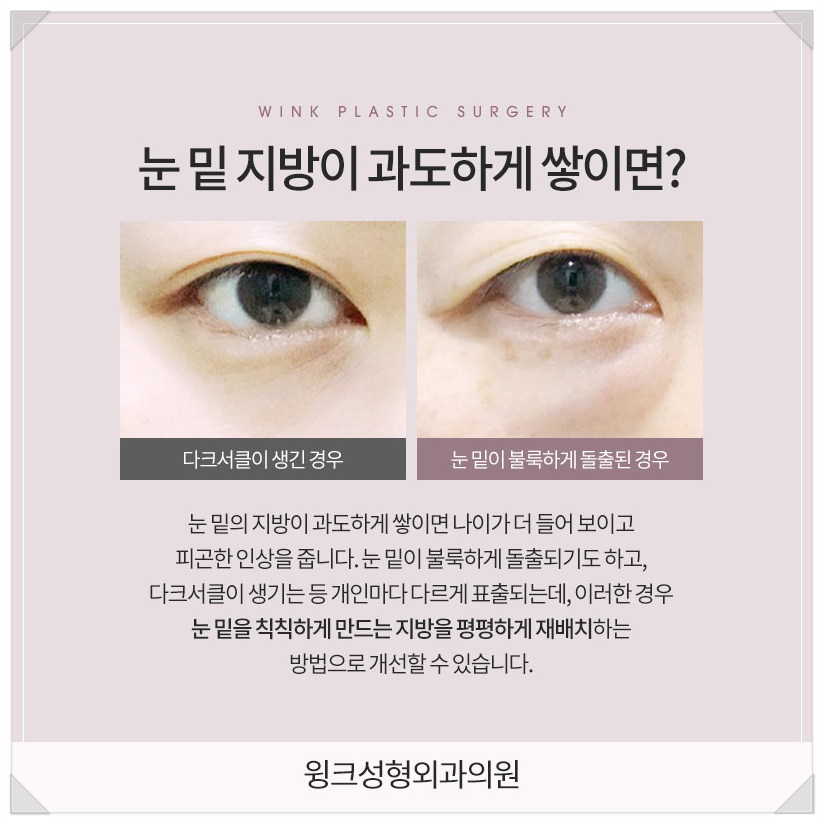 눈밑지방재배치가격좋은곳 눈밑지방재배치병원 눈밑지후기 찾는다면 윙크성형외과 관련 이미지 2