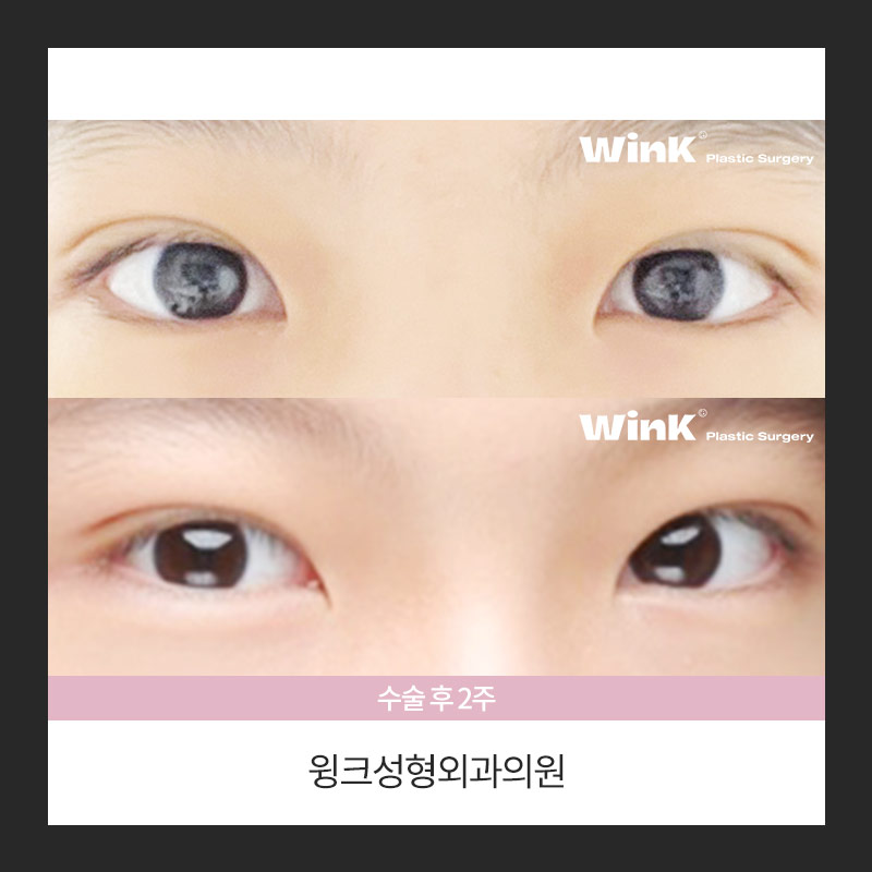 자연유착 쌍꺼풀 수술에 대해 알아보겠습니다. 관련 이미지 4