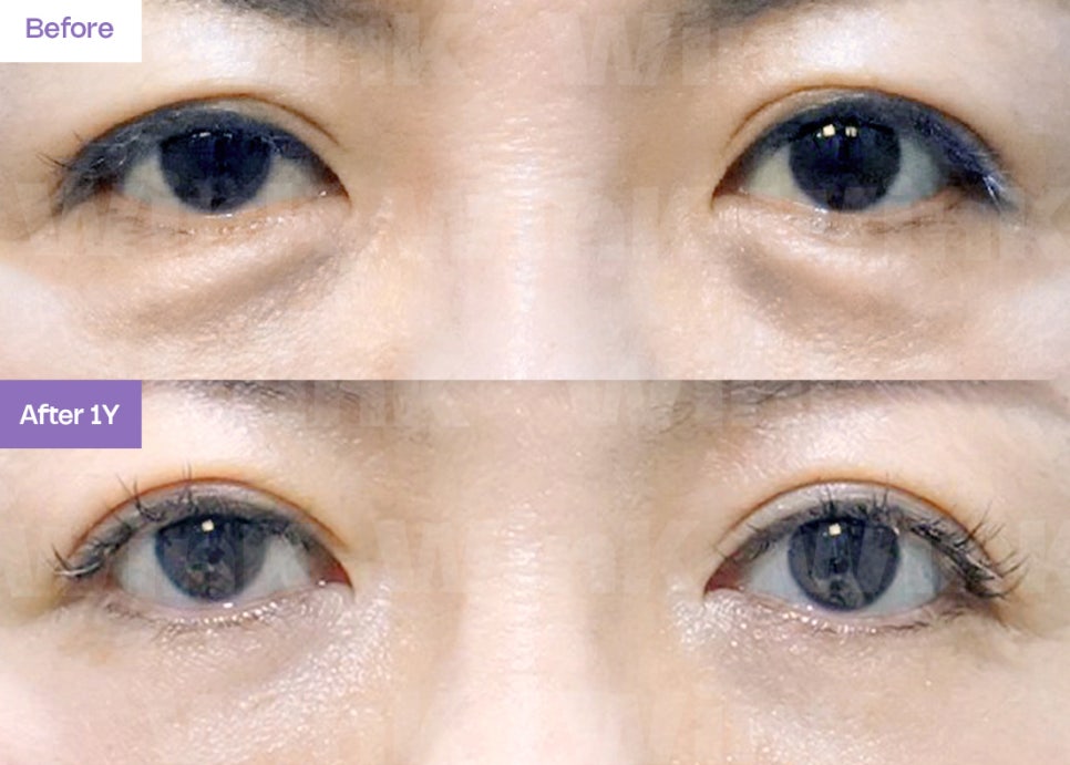 Can Upper and Lower Eyelid Surgery Be Done at the Same Time? image 1