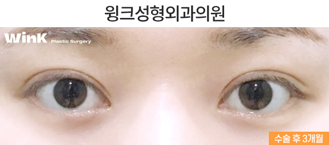 통통한 쌍꺼풀과 겹주름, 해결 방법은? 관련 이미지 6