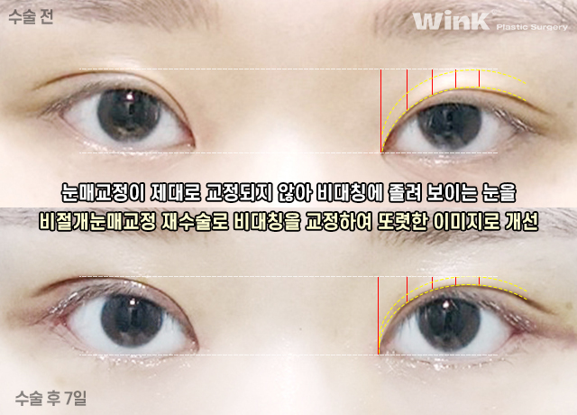 눈동자 노출량을 키워주어 또렷한 눈매로 만들어주는 윙크성형외과 눈매교정! 관련 이미지 5