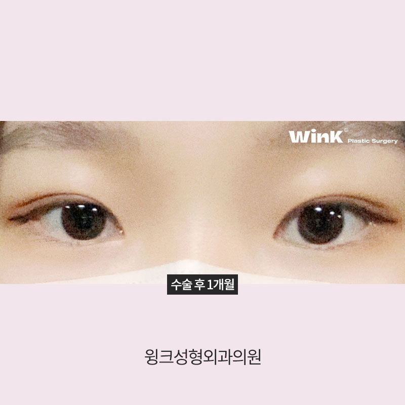 A Natural Line That Looks Just Like Your Original Eyes: In-line Double Eyelids image 9