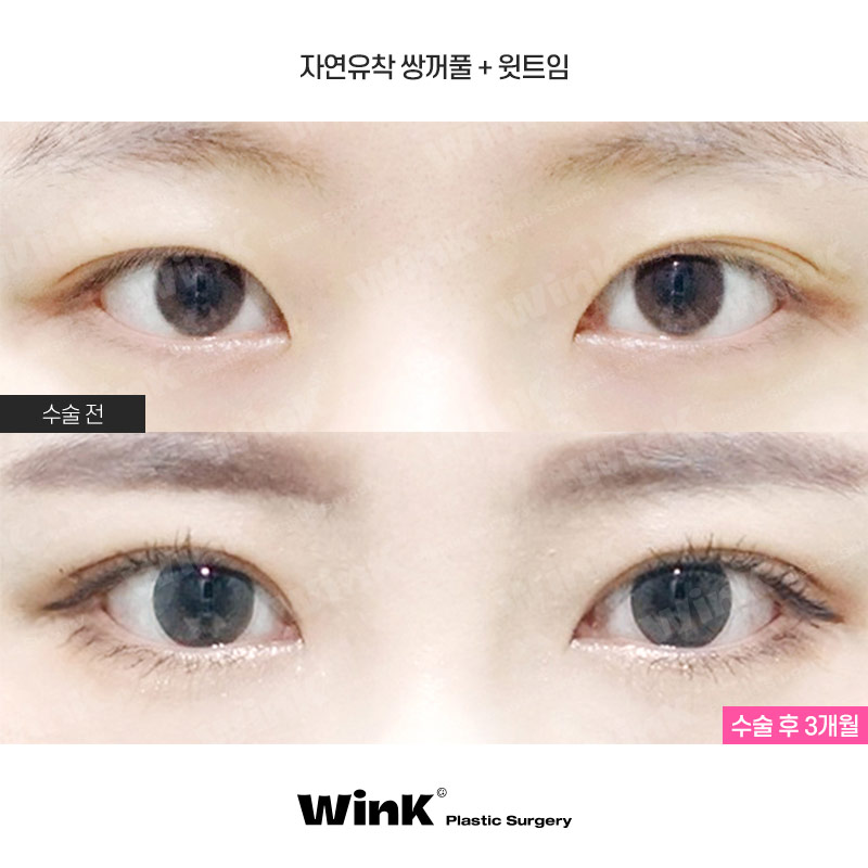 Fast Return to Daily Life and Natural Lines with Wink Natural Adhesion! image 1