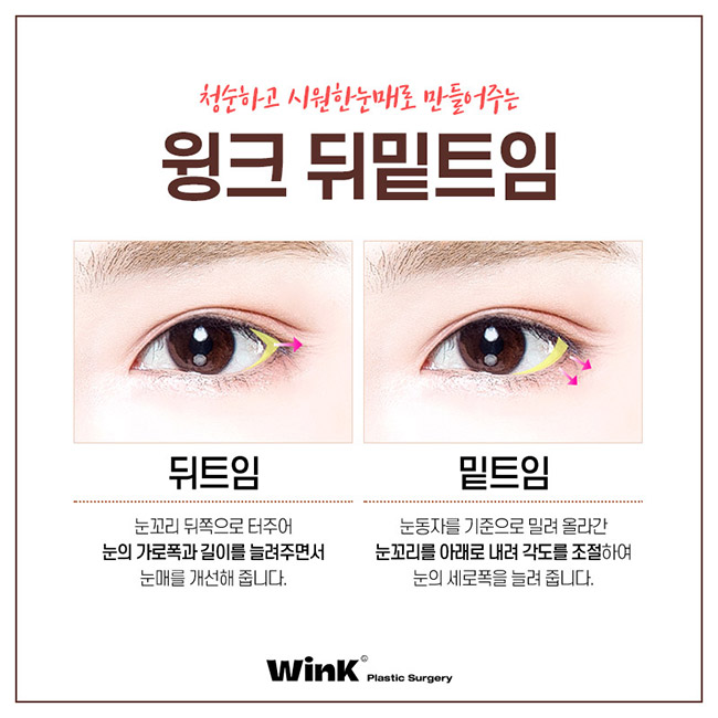 Wink canthoplasty and lower canthoplasty to overcome a cramped-looking eye shape! image 5
