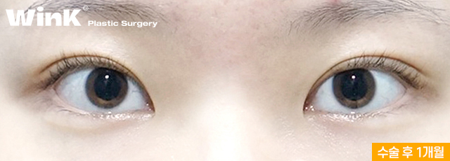 Wink Plastic Surgery’s Non-Incisional Ptosis Correction for Clearer Eyes Without an Incision! image 4
