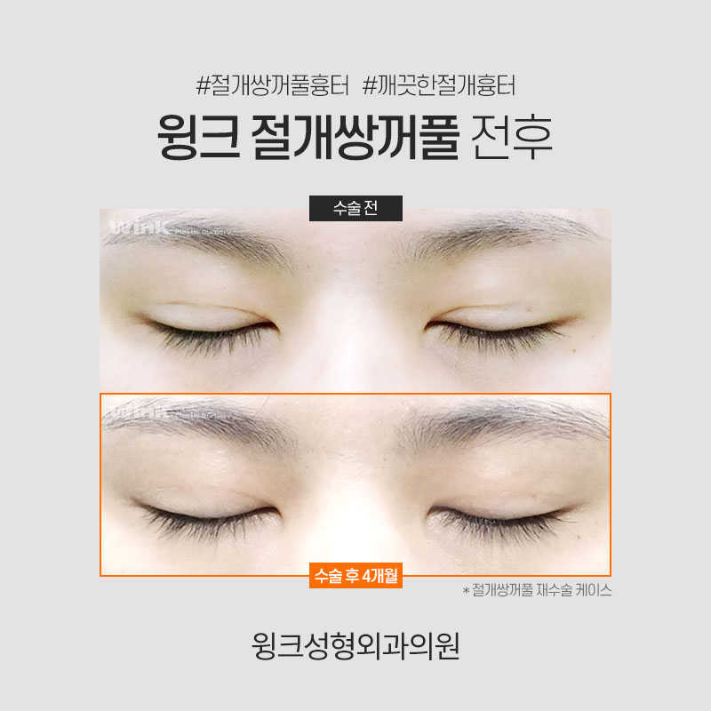 쌍꺼풀 깊은 고정 풀기 관련 이미지 8