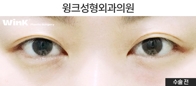 Lower Eyelid Fat Repositioning: Who Is It Effective For? image 2