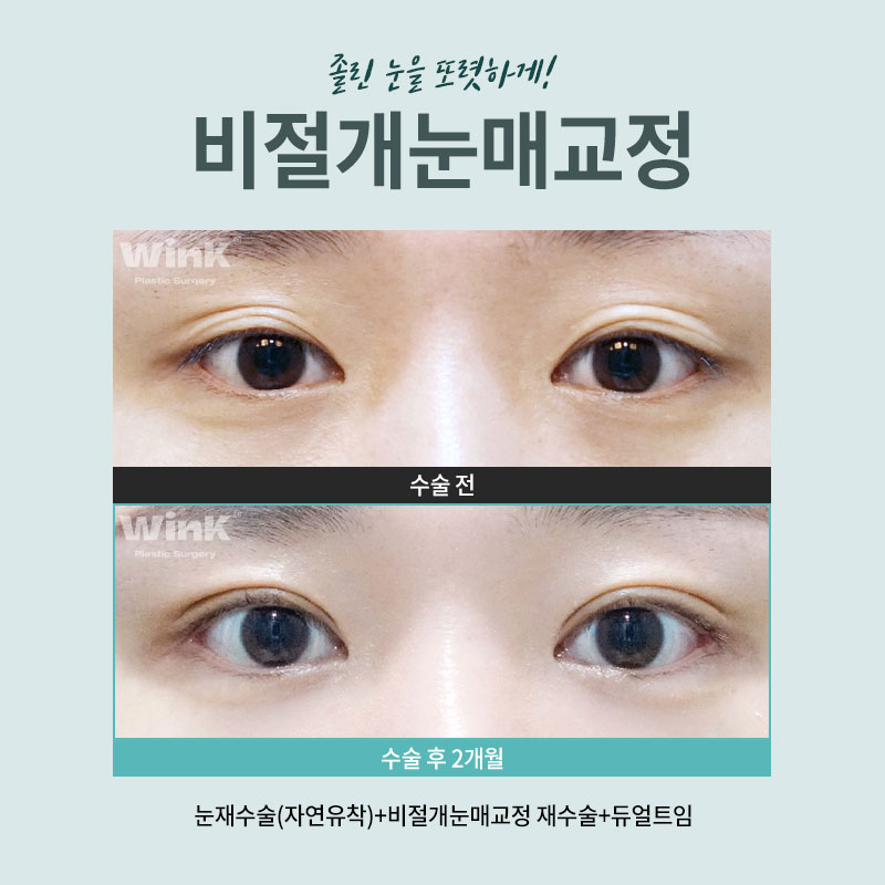 Sinsa Station Eye Correction Review | Sinsa Eye Correction Specialist | Wink Plastic Surgery | Non-Incisional Eye Correction image 6
