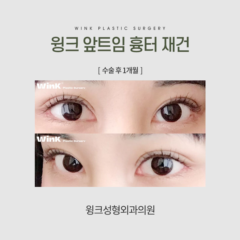 앞트임 흉 재건에 대해 알아보겠습니다. 관련 이미지 6