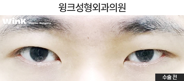 남자 속쌍꺼풀 눈매교정에 대해 알아볼까요? 관련 이미지 2