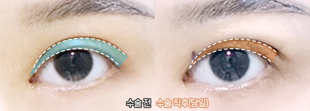 높고 깊은 고정으로 생긴 소세지눈, 윙크성형외과 두줄따기로 라인낮추기! 관련 이미지 4