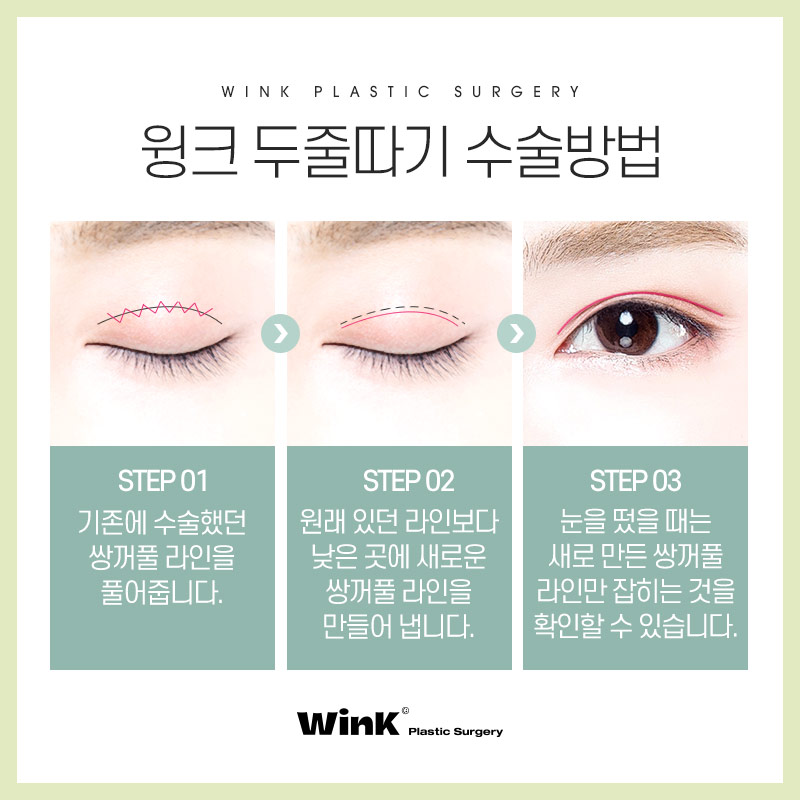 두꺼운 소세지눈? 윙크성형외과 두줄따기 눈재수술로 라인낮추기! 관련 이미지 4