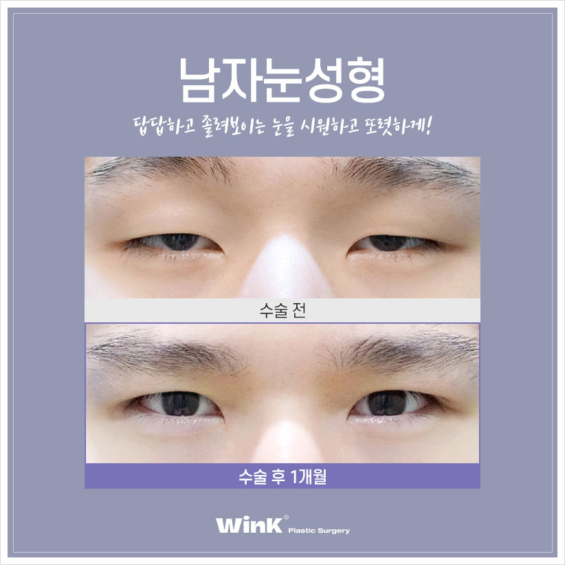 윙크성형외과 남자무쌍수술  남자눈매교정술 남자눈매교정비용 관련 이미지 3