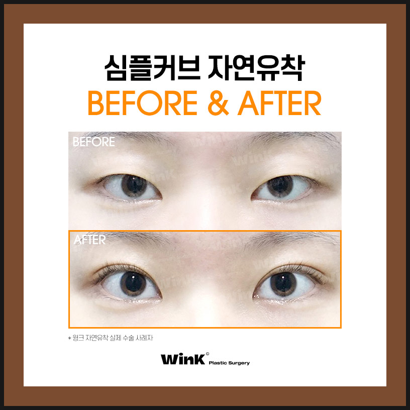 Shinsa Natural Adhesion Double Eyelid Review | Natural Adhesion Double Eyelid Surgery | Wink Plastic Surgery | Natural Adhesion Double Eyelids image 7