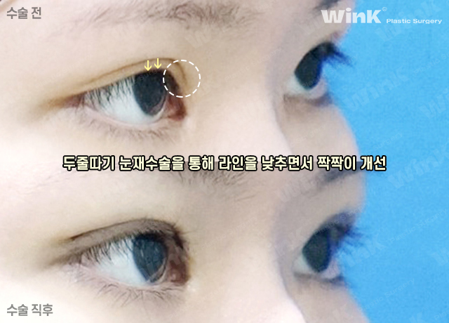 두줄따기 눈재수술로 수술 직후에도 자연스럽게! 관련 이미지 4