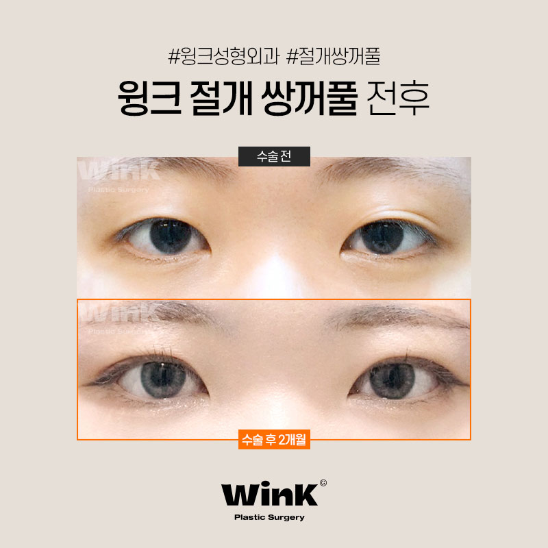 Wink Plastic Surgery Incisional Double Eyelid Surgery Offers Fast Recovery with Minimal Bruising and Swelling! image 6