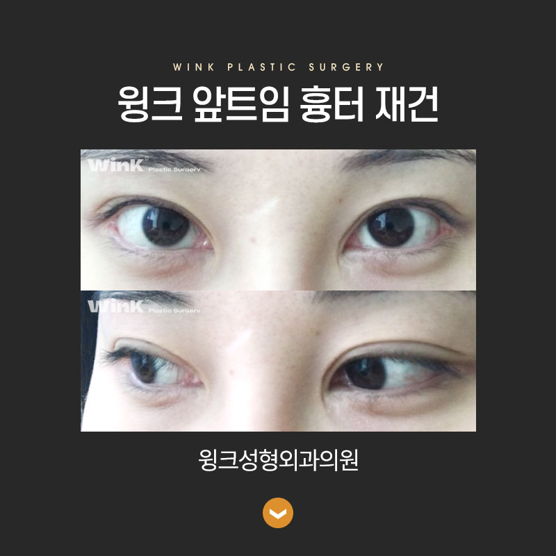 Canthal scar after epicanthoplasty? Learn about epicanthoplasty scar reconstruction with Wink Plastic Surgery. image 4