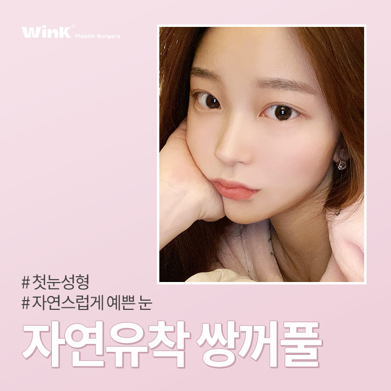 자연유착 쌍꺼풀 수술에 대해 알아보겠습니다. 관련 이미지 1