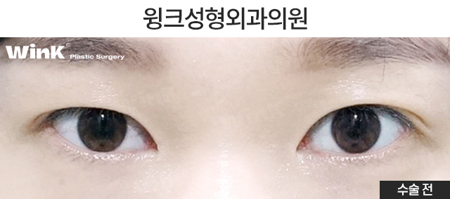 What Are the Important Factors for Successful Revision Eye Surgery? image 5
