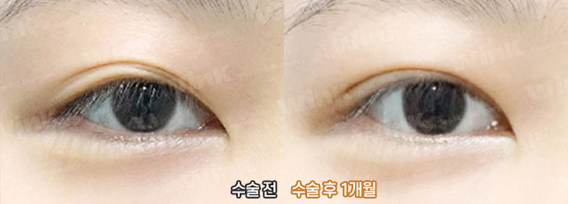 다 같은 라인? 윙크성형외과 심플커브 자연유착은 나에게 꼭 맞는 라인으로! 관련 이미지 10