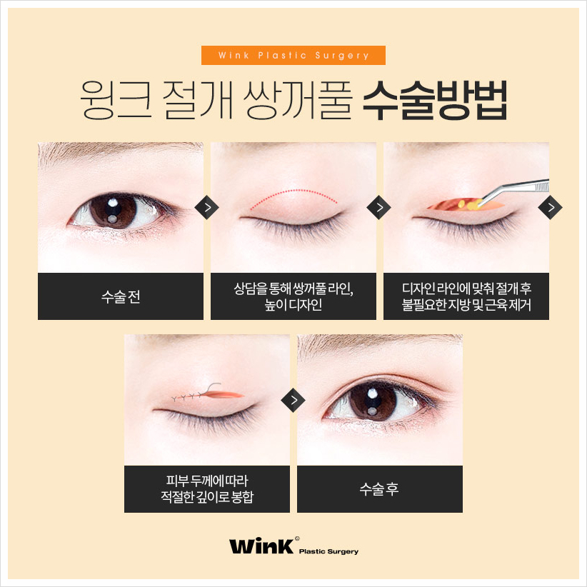쌍수잘하는곳? 윙크성형외과 절개쌍꺼풀 쌍수절개붓기 관련 이미지 3