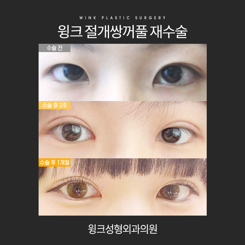 절개 쌍수 재수술에 대해 알아보겠습니다. 관련 이미지 5