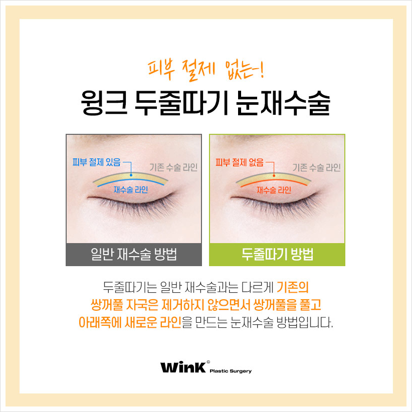 Sausage Eyes After Double Eyelid Surgery: If You’re Concerned About a Bulky Double Eyelid, Wink Plastic Surgery’s Double Eyelid Line Lowering and Sausage Eye Revision Surgery Costs image 4