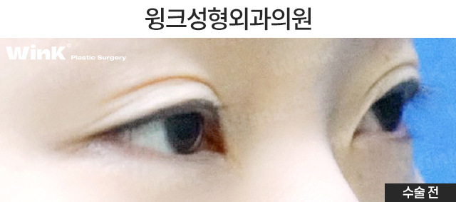 Case Examples of Correcting Uneven Eyes Through Ptosis Correction image 4