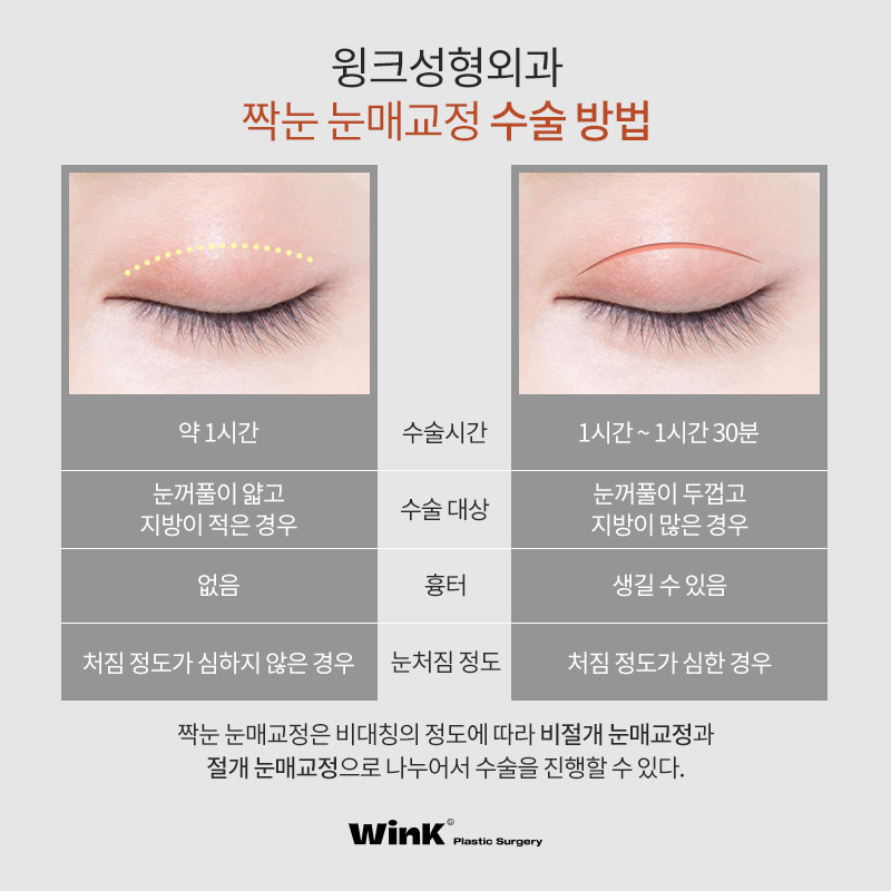 짝눈, 눈매교정으로 개선할 수 있을까? 윙크성형외과 눈매교정으로 가능해! 관련 이미지 6