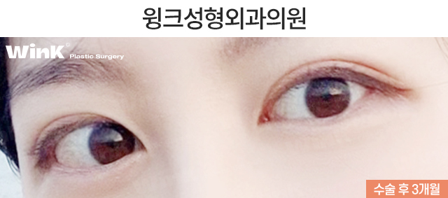 자연유착 재수술 시 주의점에 대해 알아보겠습니다. 관련 이미지 3