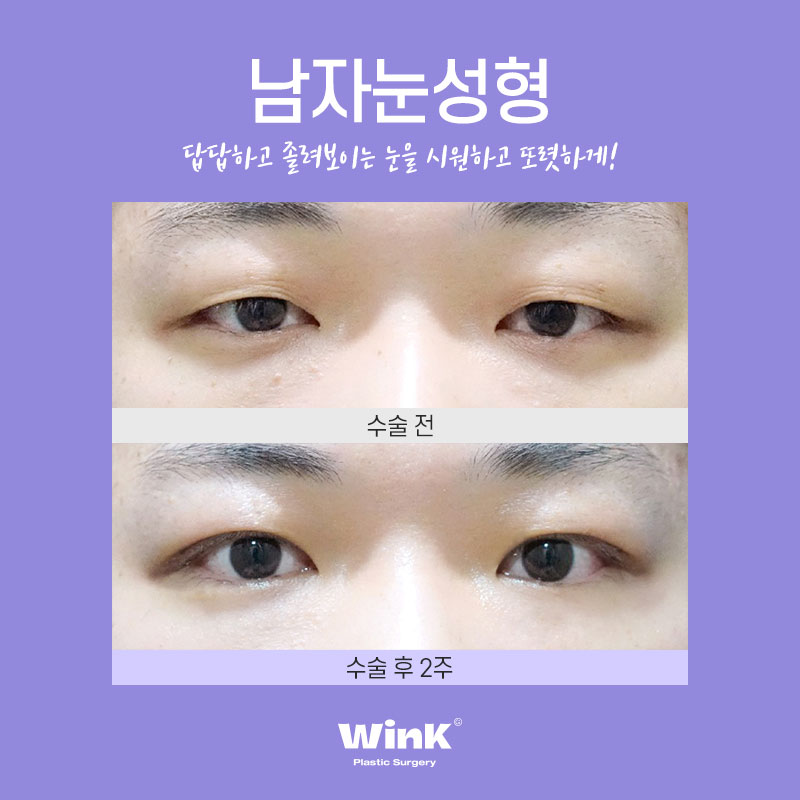 Men’s Eye Surgery: Won’t It Feel Too Much? With WINK Plastic Surgery, for a Natural and Defined Line! image 5